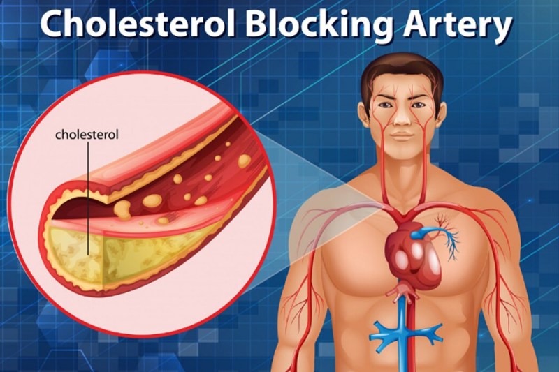 Early Signs of Blocked Arteries