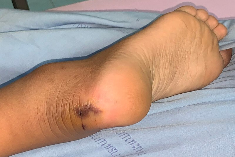 Snake bite in Anganwadi
