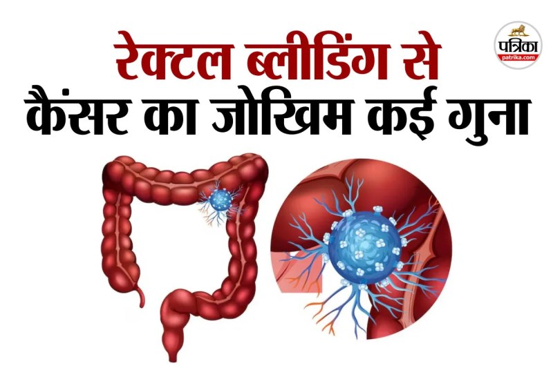 Colorectal Cancer Risk,colorectal cancer,rectal bleeding,