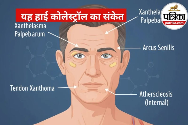 Early Signs of High Cholesterol