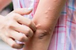 Japanese encephalitis