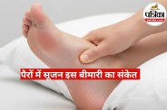 Swelling in Feet