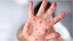 The health department has issued an alert regarding tomato flu in children
