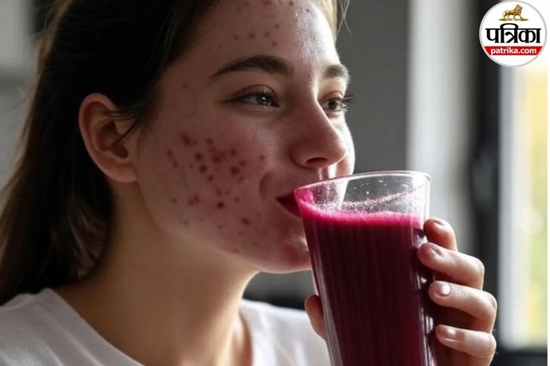 How to use beetroot for face acne, How to remove dark spots with beetroot, Does eating beetroot clear skin,