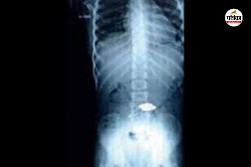 CG News: 8 साल के बच्चे के सीने में फंसी सिक्के जैसी चीज, अस्पताल ले जाते समय मौत...(photo-patrika)