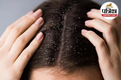 Dandruff Remedies, Dandruff Home Remedies, tips to avoid dandruff in winter,