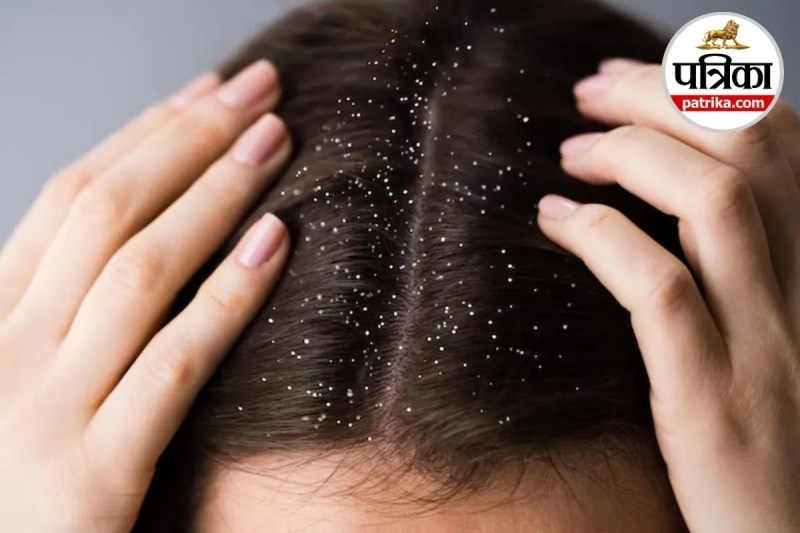Dandruff Remedies, Dandruff Home Remedies, tips to avoid dandruff in winter,
