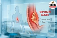 Esophageal Cancer Symptoms
