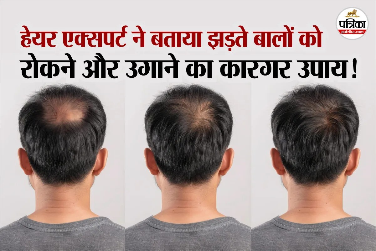 Hair Loss expert tips, regrow hair treatment, ganjapan kaise roke,