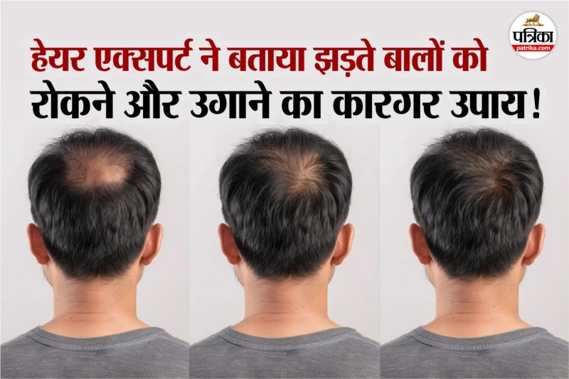 Hair Loss expert tips, regrow hair treatment, ganjapan kaise roke,