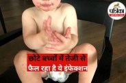 Hand Foot and Mouth Disease