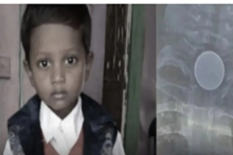 CG News: 8 साल के मासूम के सीने में सिक्का फसा, इलाज के दौरान मौत, परिजनों में पसरा मातम