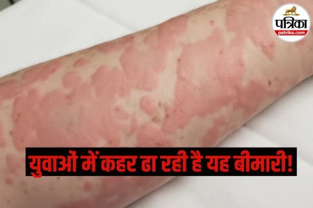 Cold Urticaria, Cold Allergy, Cold Hives