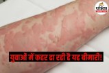 Cold Urticaria, Cold Allergy, Cold Hives