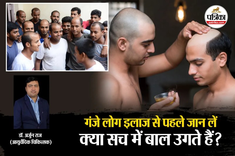 Ganjapan Ka ilaj, Ganjapan Ka Ayurvedi ilaj, baal ugane wala tel, baal ugane wala dawa,