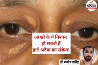 Heart attack symptoms, Xanthelasma heart risk, आंखों के नीचे पीली गांठ, heart health, xanthelasma symptoms, cholesterol symptoms on eyelids