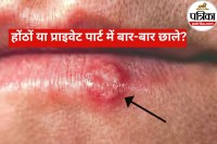 Herpes Simplex Virus