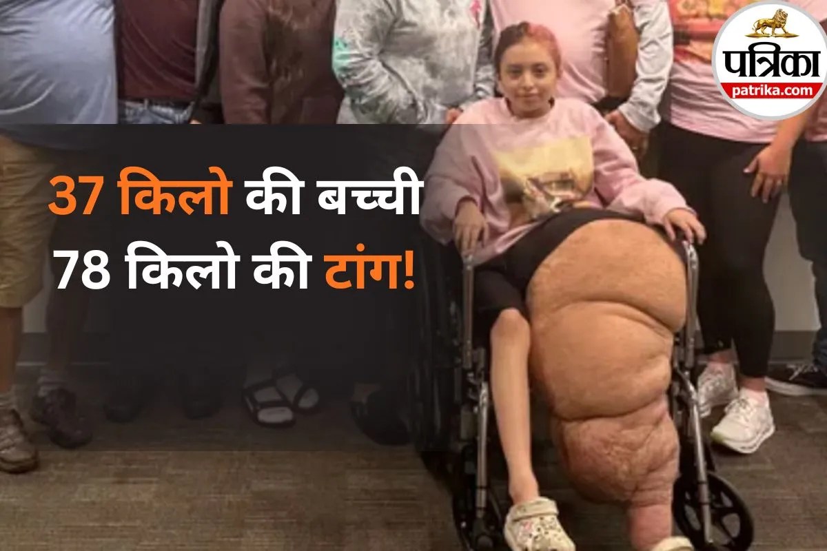 Leg Overgrowth Disorder