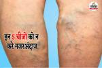 varicose veins, indore news