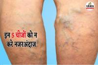 varicose veins, indore news