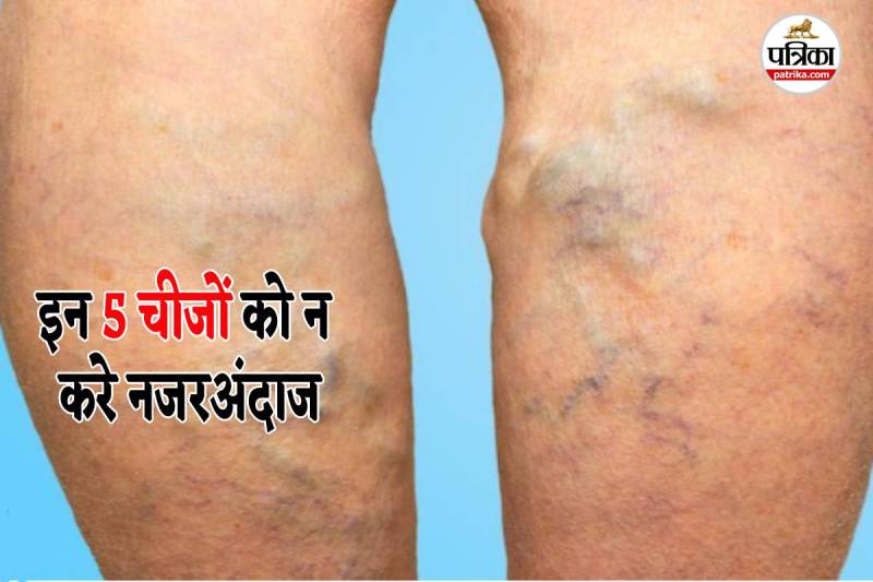varicose veins, indore news