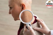 Skin Cancer Signs