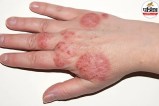 Winter Eczema, Atopic Dermatitis