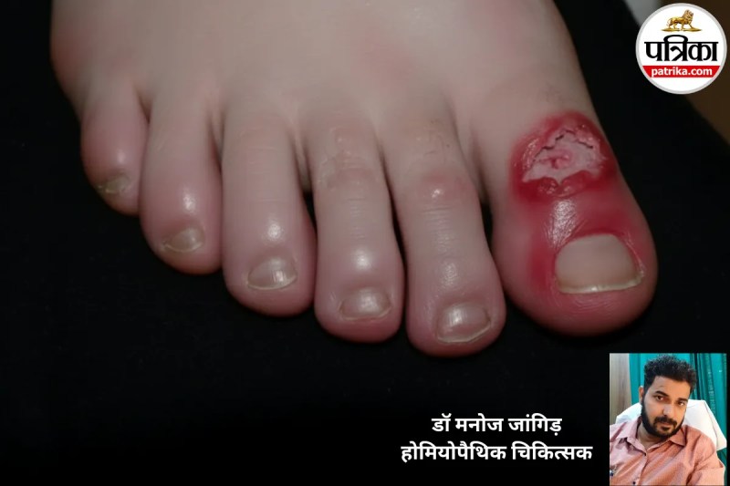 Winter Swelling In Fingers, frostbite fingers