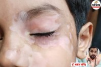 skin disease, Skin Disease Vitiligo, Skin Disease Vitiligo symptoms