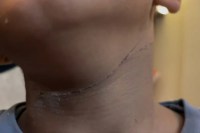 Child’s Throat Severed by Kite String