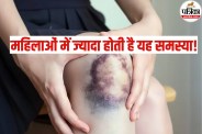 Bruising without injury