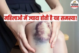 Bruising without injury
