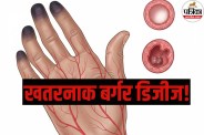 Buerger Disease