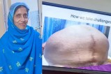 Delhi AIIMS doctors extraordinary surgery removing 20 kg tumor from woman body battling cancer