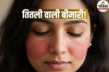 Lupus Disease