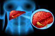 Fatty liver