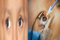 CG News: नन्हीं आंखों पर खतरा, बच्चों की आंखों पर मोतियाबिंद का साया, डॉक्टरों ने अब तक 10 के आंखों की रोशनी लौटाई