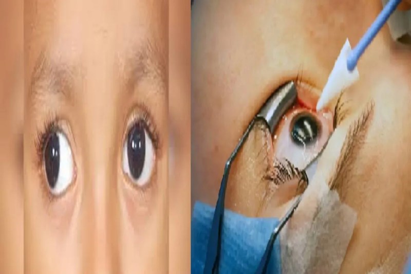 CG News: नन्हीं आंखों पर खतरा, बच्चों की आंखों पर मोतियाबिंद का साया, डॉक्टरों ने अब तक 10 के आंखों की रोशनी लौटाई