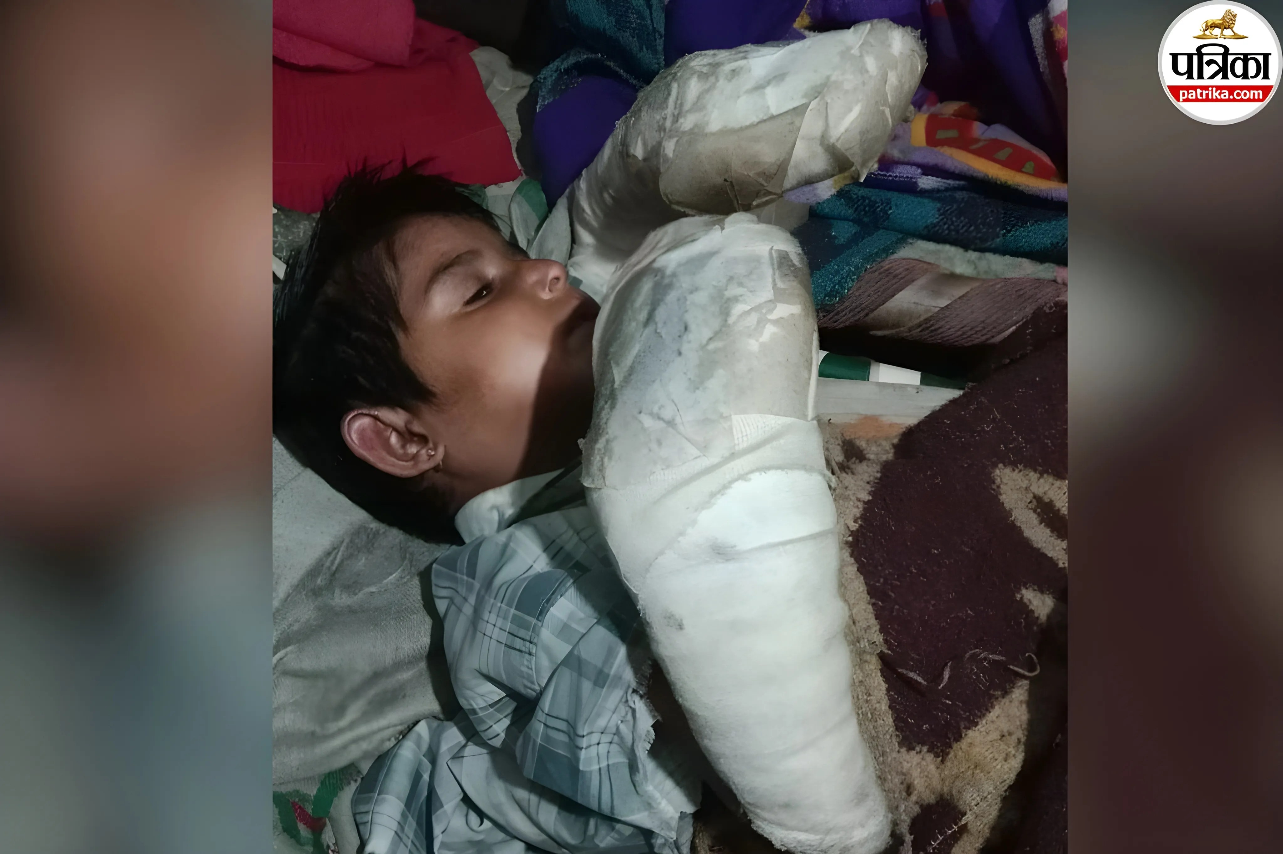 Epidermolysis Bullosa case India