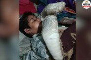 Epidermolysis Bullosa case India