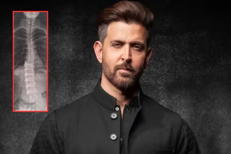 ऋतिक रोशन अपनी फिटनेस के लिए जाने जाते हैं, लेकिन जब वह अपने करियर की शुरुआत करने वाले थे उस समय उन्हें कुछ ऐसी बीमारी हुई थी जिसकी वजह से डॉक्टर्स ने उन्हें एक्टिंग से दूर रहने की सलाह दी थी।