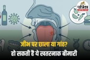 Tongue Cancer Causes