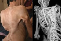 Rajasthan Reports First Stone Man Syndrome Case Rare FOP Disease Slowly Turns Muscles Into Bone Doctors Stunned
