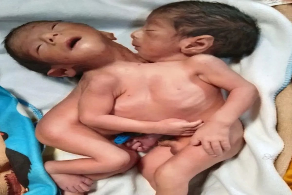 एक ही शरीर से जुड़े दो बच्चे जन्मे
