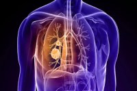 Lung Cancer