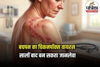 Shingles Symptoms