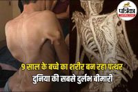 Stone MStone Man Syndromean Syndrome