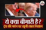 Red marks on neck area, Trump Neck Skin Issue, Trump Neck Skin photo viral, US Israel Attacks Iran,