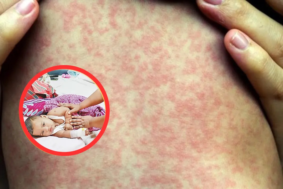 Bangladesh Health Crisis Measles