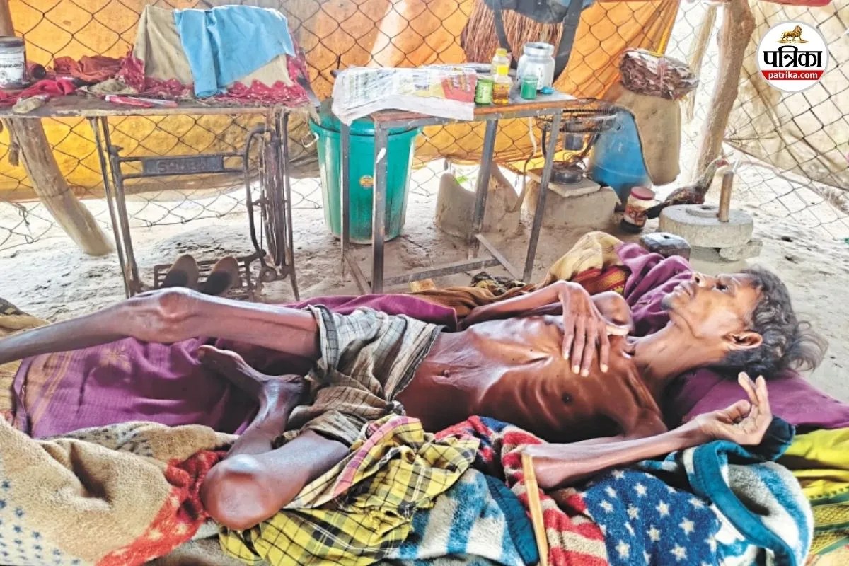 बीमारी से कंकाल बना शरीर (फोटो सोर्स- पत्रिका)